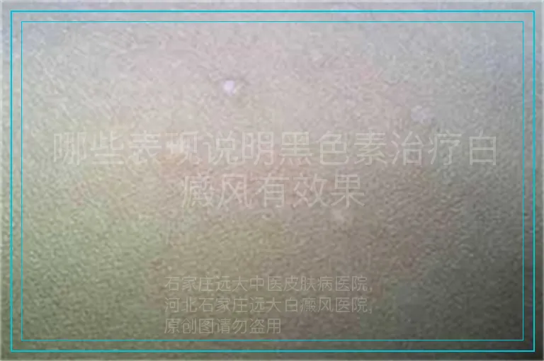 哪些表现说明黑色素治疗白癜风有效果