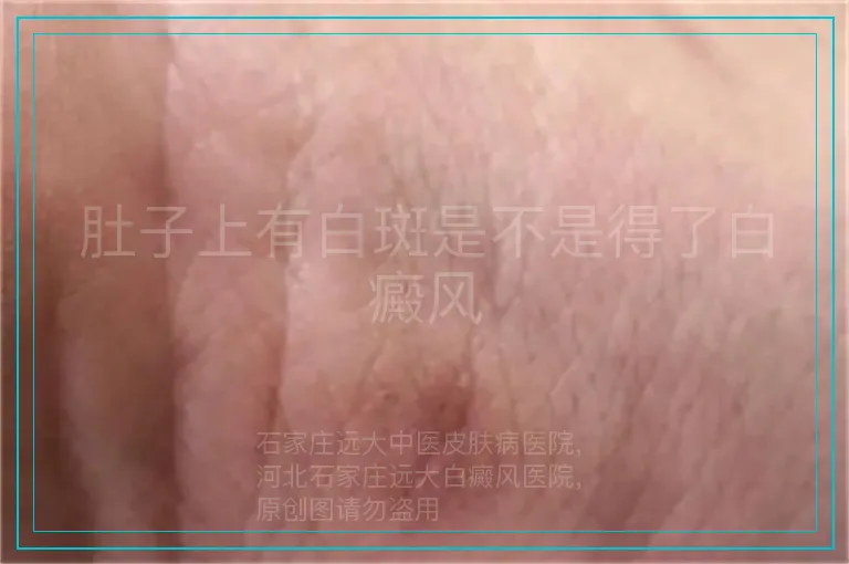 肚子上有白斑是不是得了白癜风