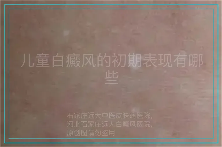 儿童白癜风的初期表现有哪些