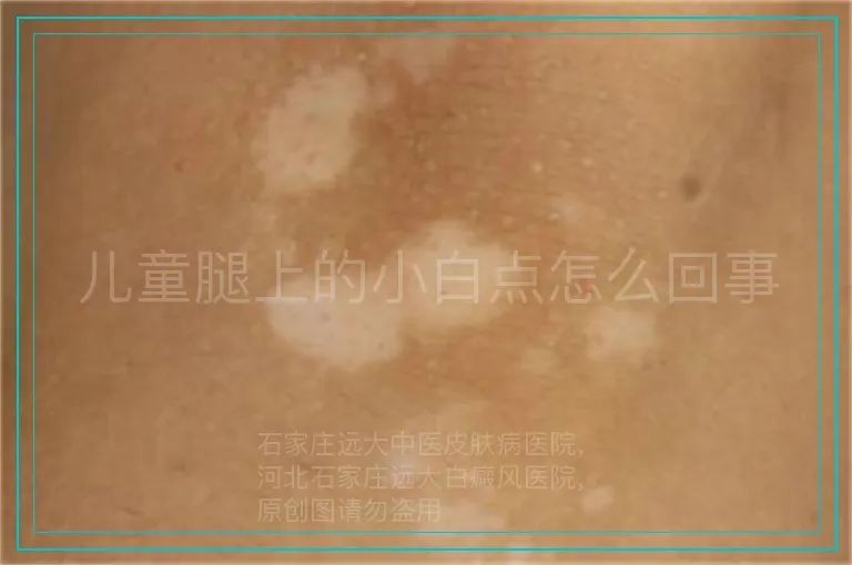 儿童腿上的小白点怎么回事
