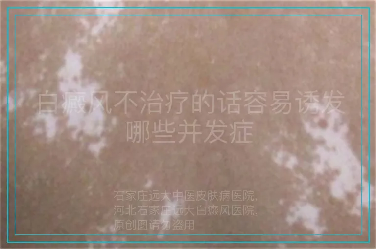白癜风不治疗的话容易诱发哪些并发症