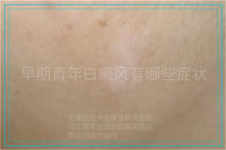 早期青年白癜风有哪些症状