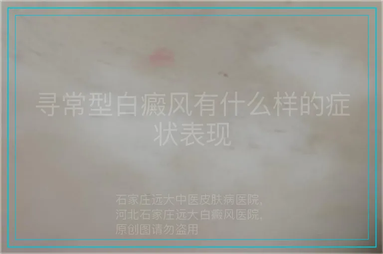 寻常型白癜风有什么样的症状表现