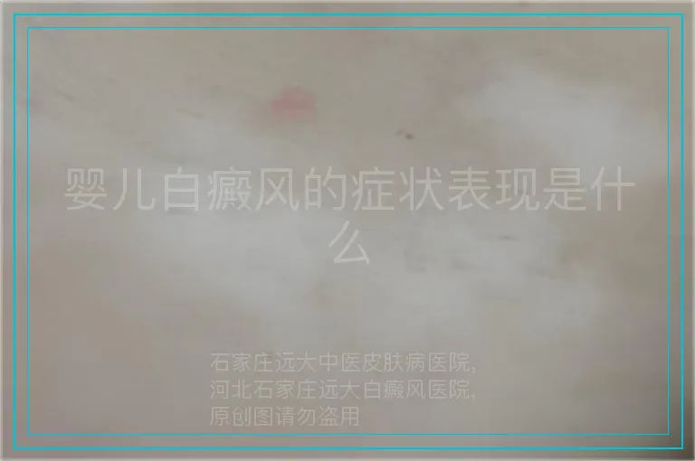 婴儿白癜风的症状表现是什么