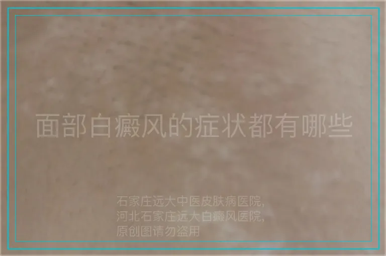面部白癜风的症状都有哪些