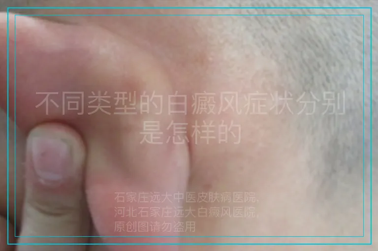 不同类型的白癜风症状分别是怎样的
