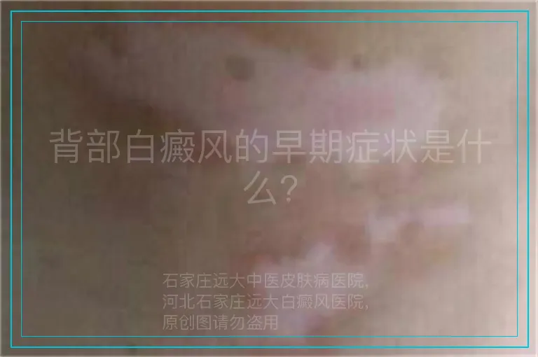 背部白癜风的早期症状是什么?