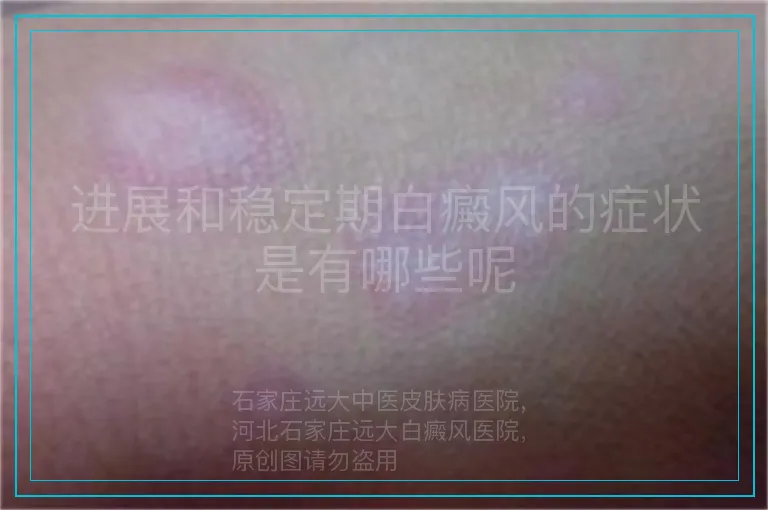 进展和稳定期白癜风的症状是有哪些呢