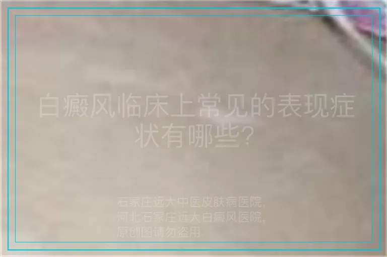 白癜风临床上常见的表现症状有哪些?