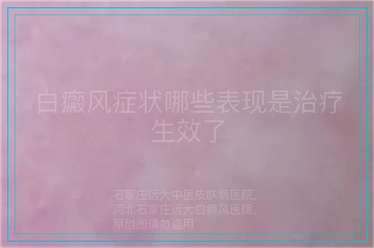 白癜风症状哪些表现是治疗生效了