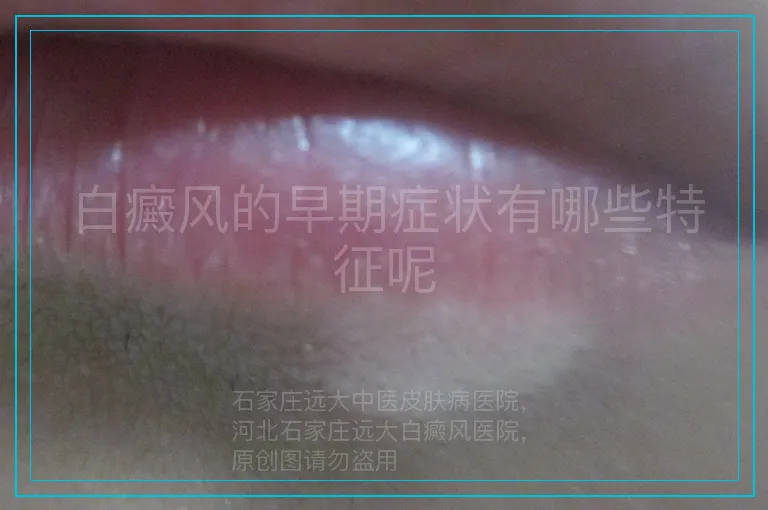白癜风的早期症状有哪些特征呢