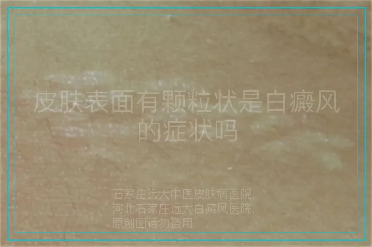皮肤表面有颗粒状是白癜风的症状吗