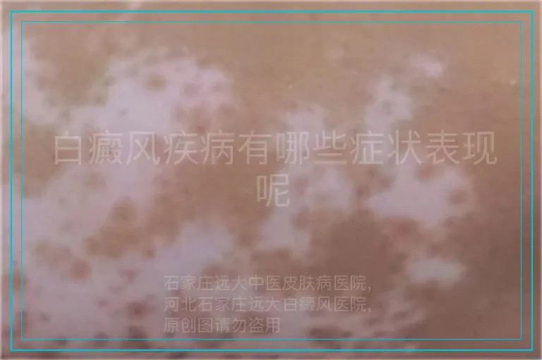 白癜风疾病有哪些症状表现呢