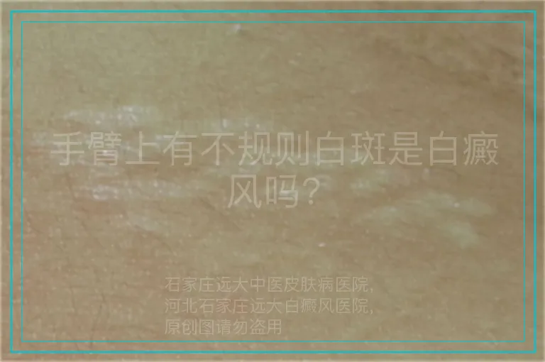 手臂上有不规则白斑是白癜风吗?