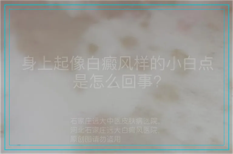 身上起像白癜风样的小白点是怎么回事?