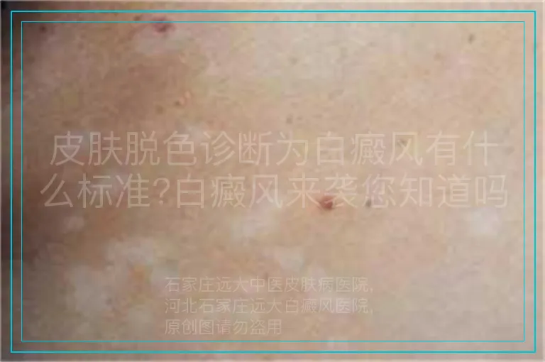 皮肤脱色诊断为白癜风有什么标准?白癜风来袭您知道吗?