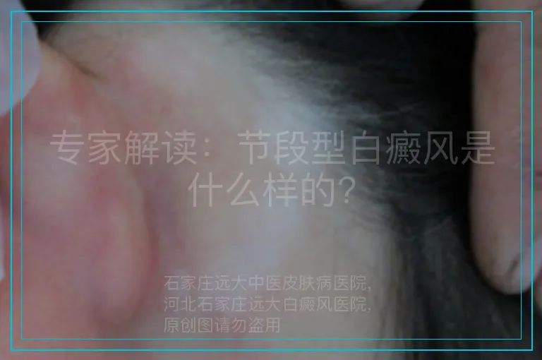 专家解读：节段型白癜风是什么样的?