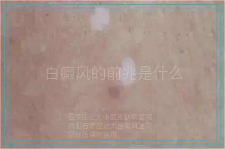 白癜风的前兆是什么