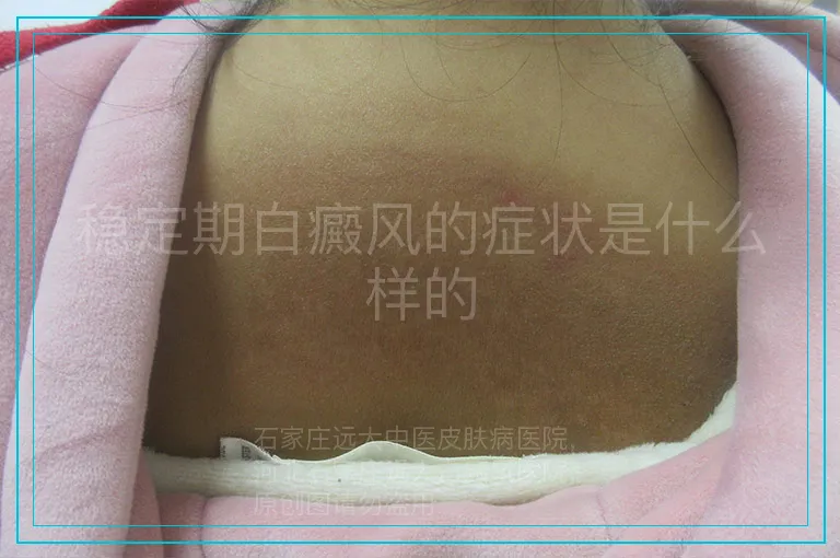 稳定期白癜风的症状是什么样的