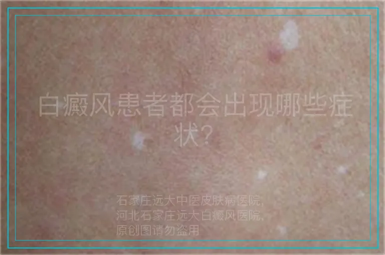 白癜风患者都会出现哪些症状?