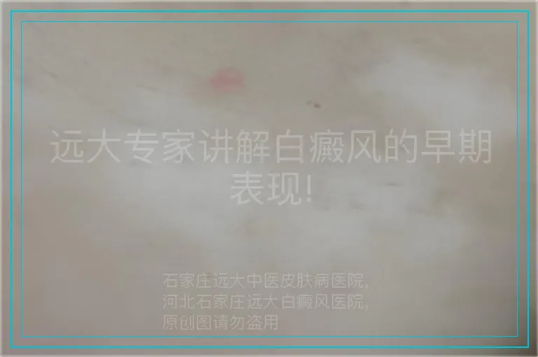 远大专家讲解白癜风的早期表现!