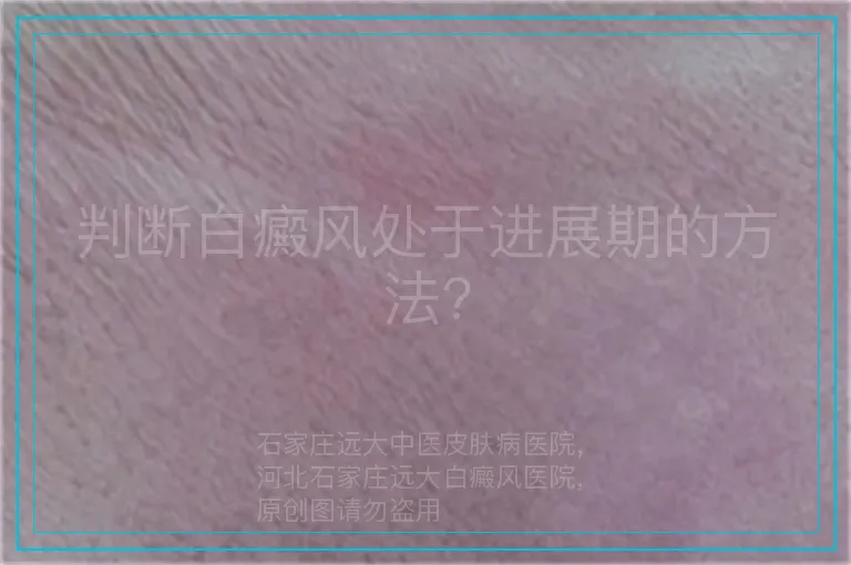 判断白癜风处于进展期的方法?