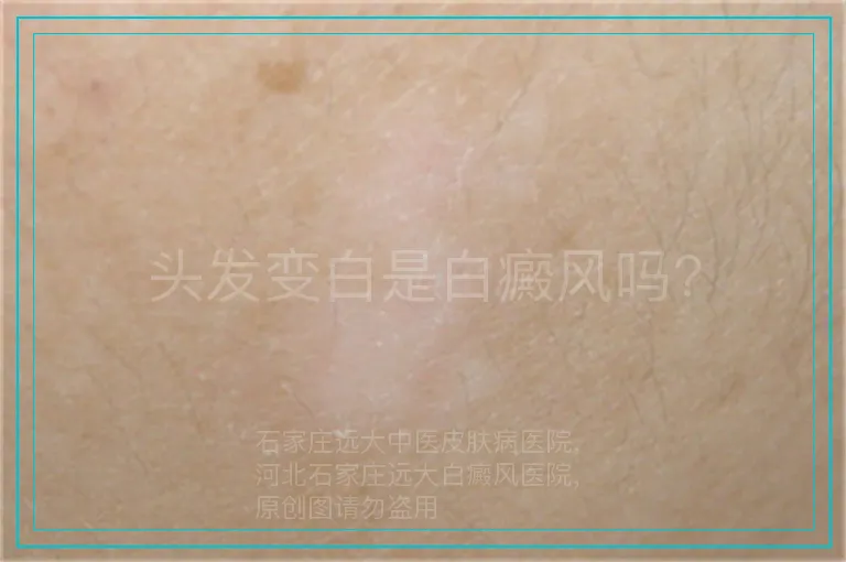 头发变白是白癜风吗?