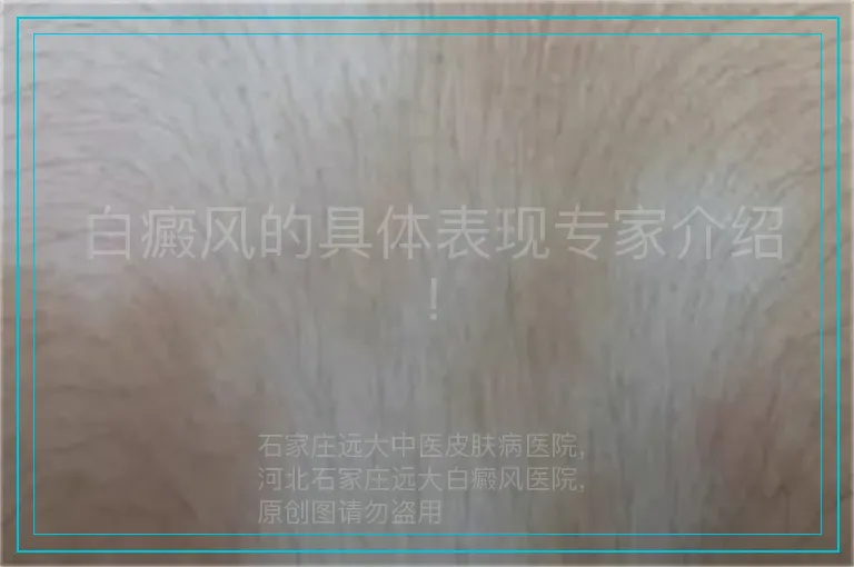 白癜风的具体表现专家介绍!
