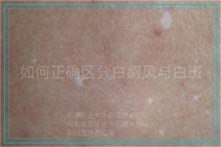 如何正确区分白癜风与白斑