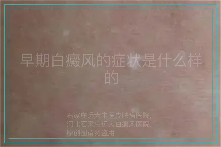 早期白癜风的症状是什么样的
