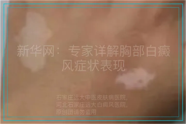 新华网：专家详解胸部白癜风症状表现