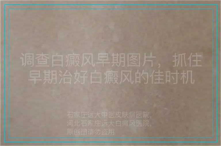 调查白癜风早期图片，抓住早期治好白癜风的佳时机