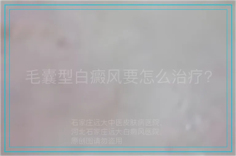 毛囊型白癜风要怎么治疗?