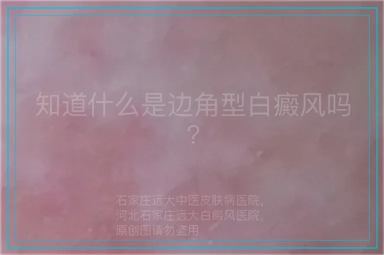 知道什么是边角型白癜风吗?