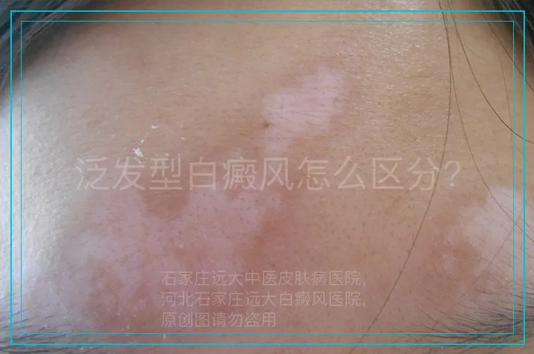 泛发型白癜风怎么区分?