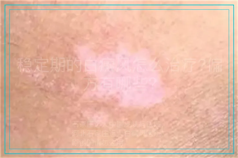 稳定期的白癜风怎么治疗?偏方有哪些?
