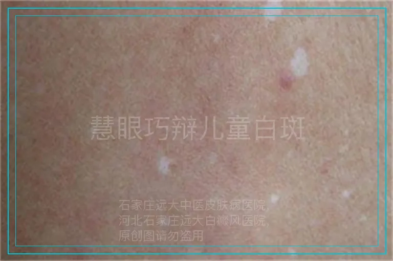 慧眼巧辩儿童白斑