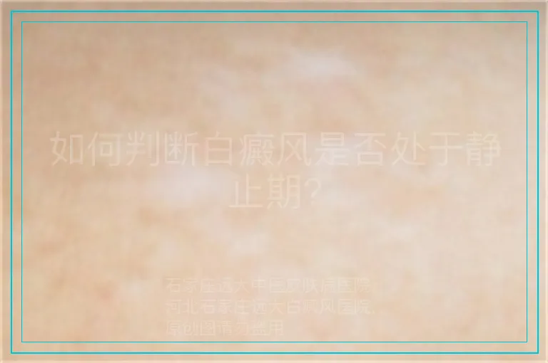 如何判断白癜风是否处于静止期?