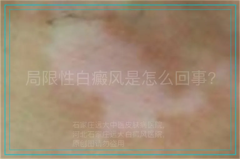 局限性白癜风是怎么回事?