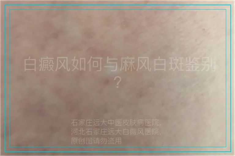 白癜风如何与麻风白斑鉴别？