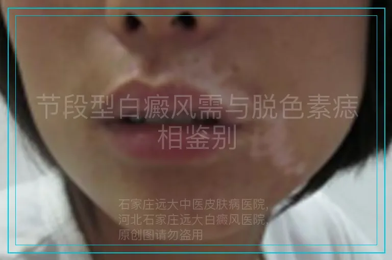 节段型白癜风需与脱色素痣相鉴别