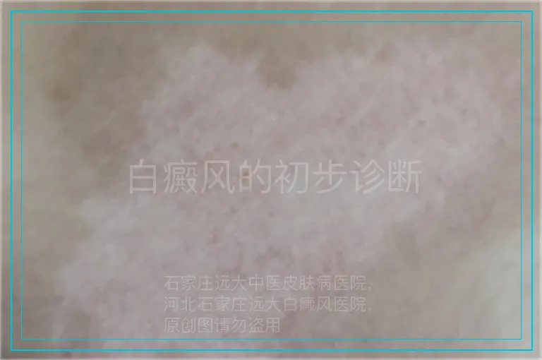 白癜风的初步诊断
