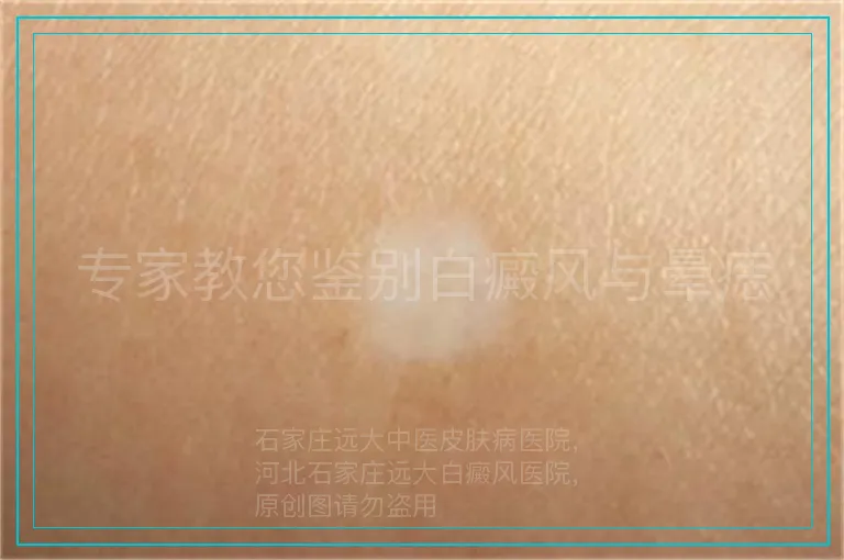 专家教您鉴别白癜风与晕痣
