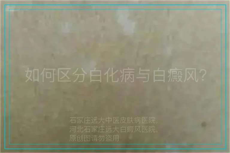 如何区分白化病与白癜风？