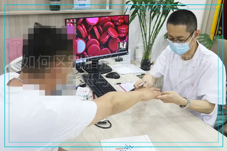 如何区别脂溢性皮炎遗留的白斑与白癜风？