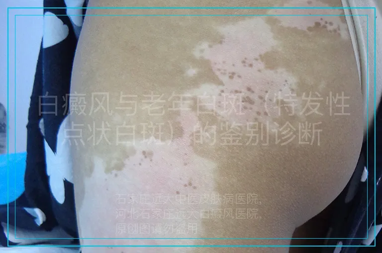 白癜风与老年白斑（特发性点状白斑）的鉴别诊断