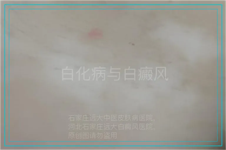 白化病与白癜风