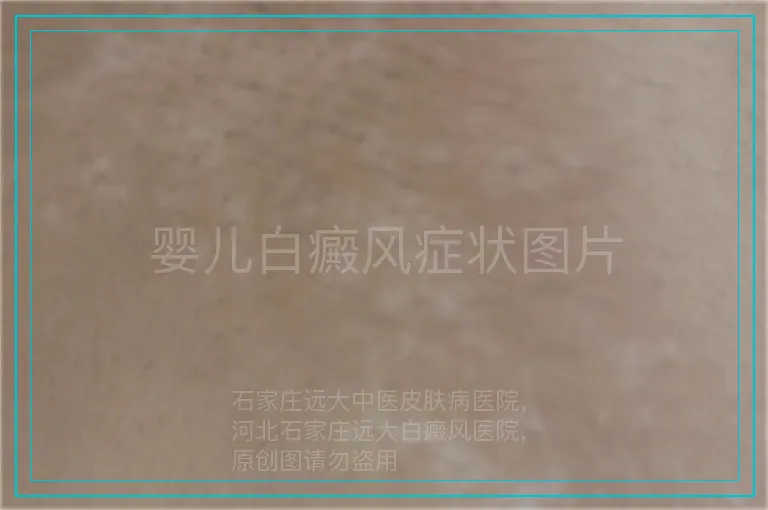 婴儿白癜风症状图片
