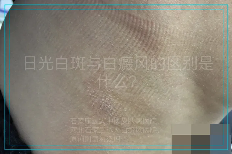 日光白斑与白癜风的区别是什么?