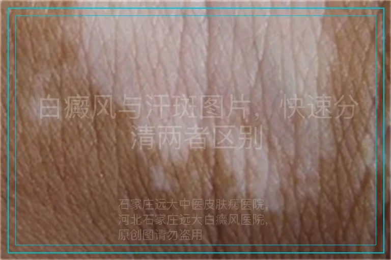 白癜风与汗斑图片，快速分清两者区别